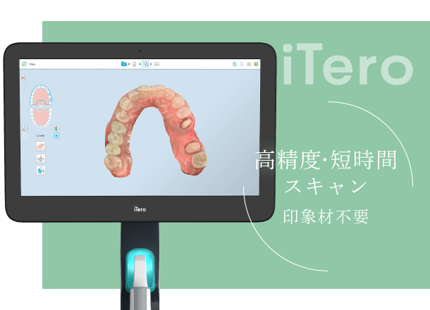 iTero　高精度・短時間スキャン　印象材不要