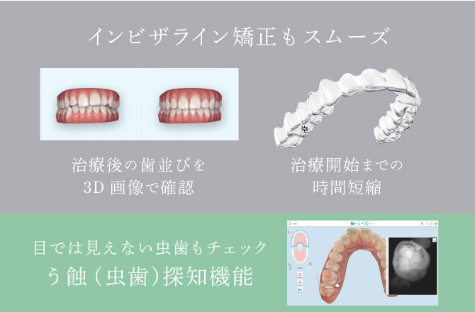 ＜インビザライン矯正もスムーズ＞治療後の歯並びを3D画像で確認・治療開始までの時間短縮　＜う蝕（虫歯）探知機能＞目では見えない虫歯もチェック